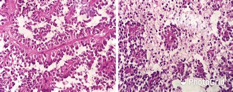 Cureus Solid Pseudopapillary Neoplasm Of The Pancreas Presenting With