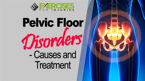 Pelvic Floor Disorders – Causes And Treatments Exercises For Injuries