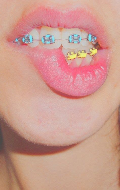 Pin By Andee On Braces Colors With Images Cute Braces Braces