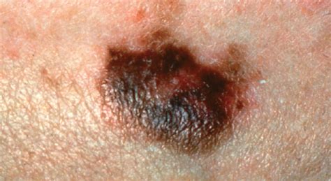 5 warning signs of melanoma health