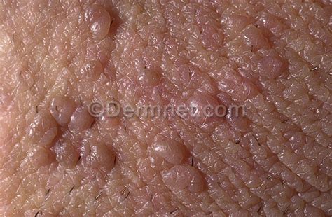 female genital warts do you want therapy with out having