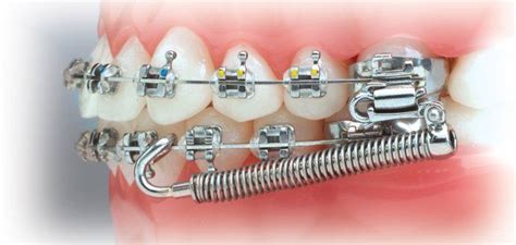 dentists in vasundhara orthodontic appliances orthodontics orthodontics braces