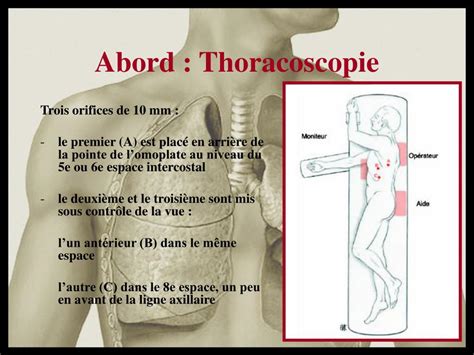 Ppt Traitement Chirurgical Du Pneumothorax Spontané Powerpoint