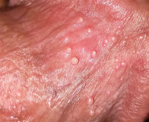 are these parafrenular glands or warts sexual health
