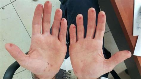 Photos Israeli Man Cuts Off Pads Of Fingers To Avoid Traffic Fees Via