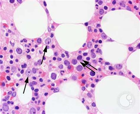 myeloid neoplasms myelodysplastic syndrome refractory ctyopenia with