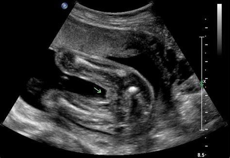 added 12w nubshot p2 gender guess for ultrasound at 20 weeks