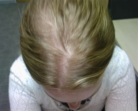 hair centre female hair loss