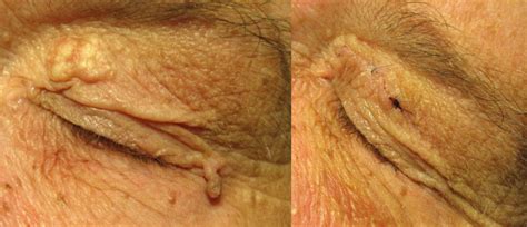 age warts removal marsden skin cancer clinic
