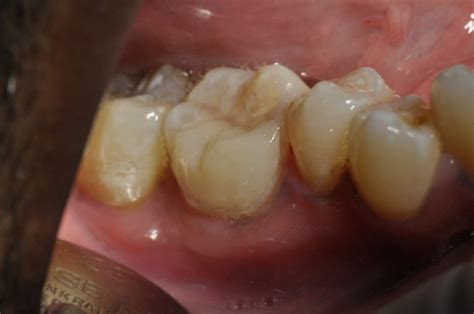Treatment Options Cases Of Restoration With Composite Resin