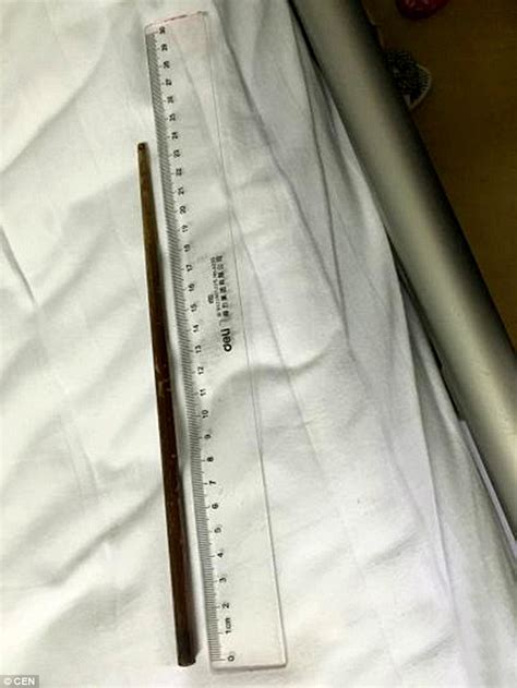 chopstick is removed from chinese woman s stomach after she swallowed