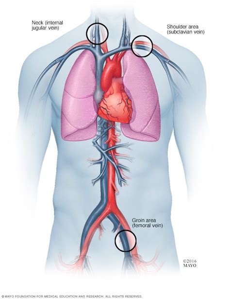 catheter insertion points for cardiac ablation mayo clinic
