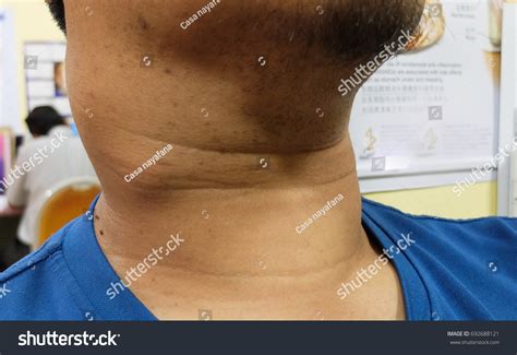 papillary thyroid cancer lymph node neck stock photo royalty