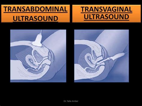 transvaginal ultrasound   dr taila amber