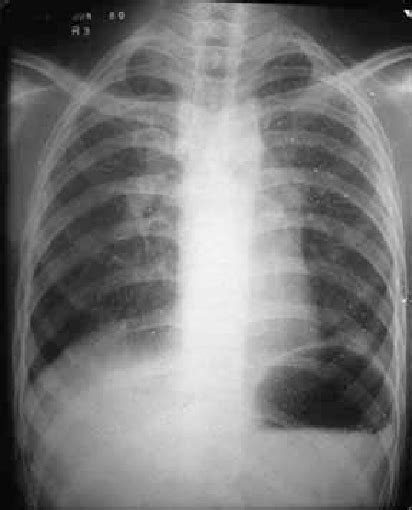 Chest X Ray 1980 Showing Bilateral Hilar And Left Paratracheal