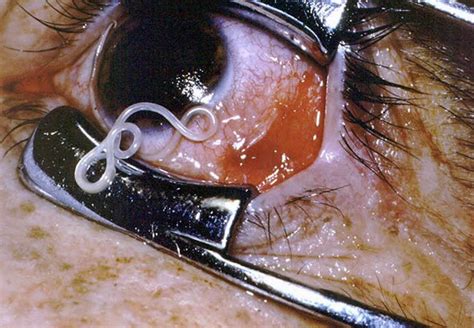 Nigeria One Of The Countries With Endemic Cases Of Eye Worm —experts