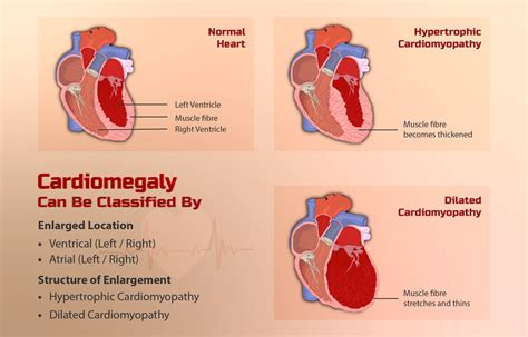 familial hypertrophic cardiomyopathy storymd