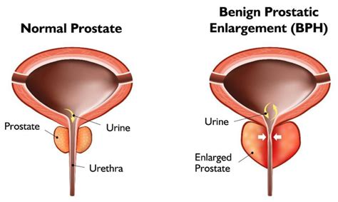 What S The Best Treatment For Enlarged Prostate