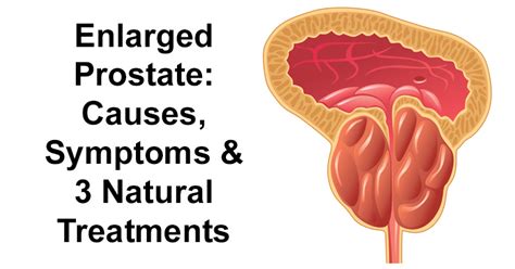 Enlarged Prostate Causes Symptoms And 3 Natural Treatments David