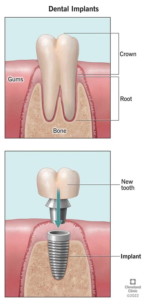 dental implants tooth implants dentures dental crowns bridges