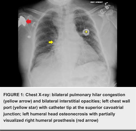 Figure 1 From Brodies Abscess Masquerading As Vaso Occlusive Crisis In
