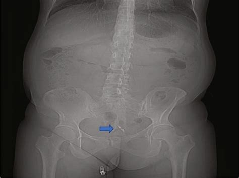 Woman S Iud Eroded Through Her Uterus And Punctured Her Bladder