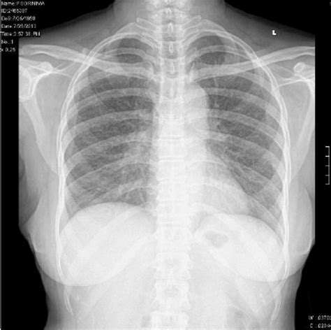Chest X Ray Showing Bilateral Hilar Prominences Download Scientific