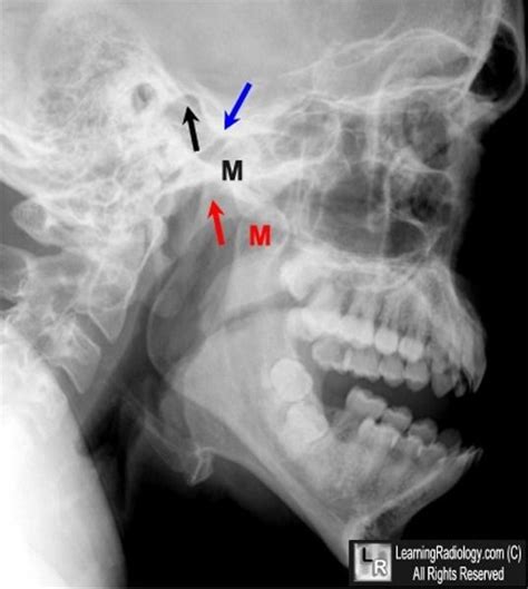 welcome to learningradiology dislocated mandible