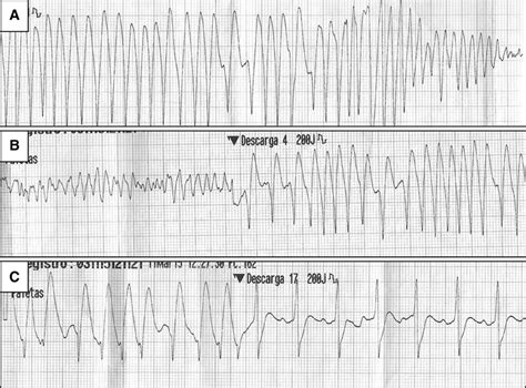 From Atrial Fibrillation To Ventricular Fibrillation And Back Circulation