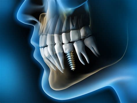 youve lost   bone  dental implants treatment