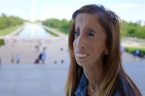 Dealing With Disorder Lizzie Velasquez Displays ‘a Brave Heart