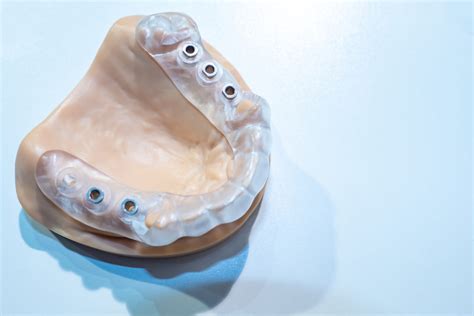 guided implants leeds dental implants hq dental
