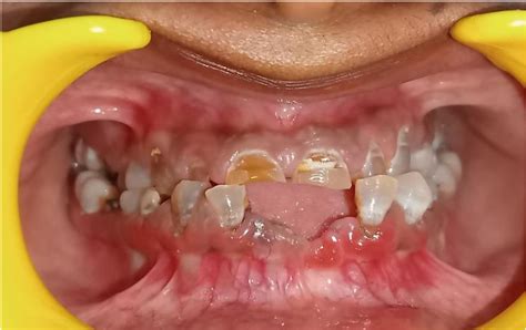 Clinical Photograph Showing Multiple Attrited Opalescent Teeth And