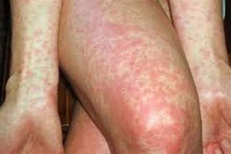 Scarlet Fever Cases Double This Winter Here S What To Look Out For