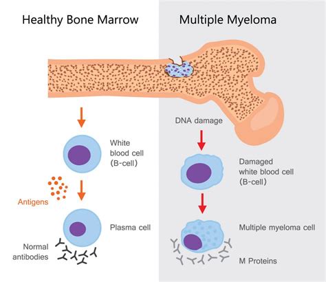 multiple myeloma diseasesandconditionsnet
