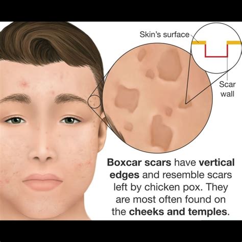 boxcar acne scars  overview  acne scars