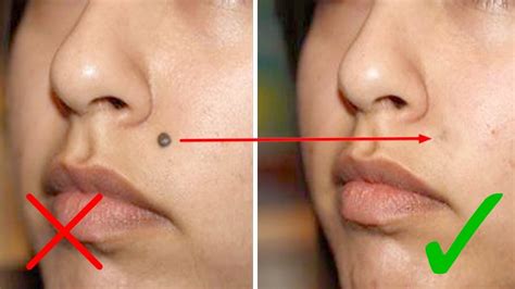 how to remove flat moles from your face health nigeria