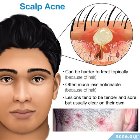 scalp acne acneorg