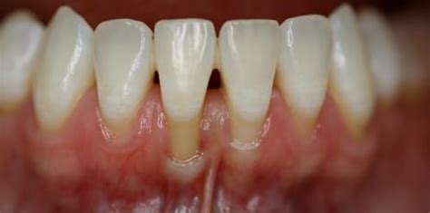 pain  gums  front teeth teethwalls