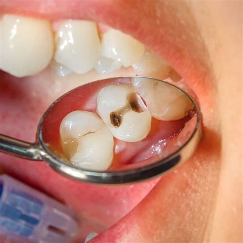 cavities  bad breath smartmouth