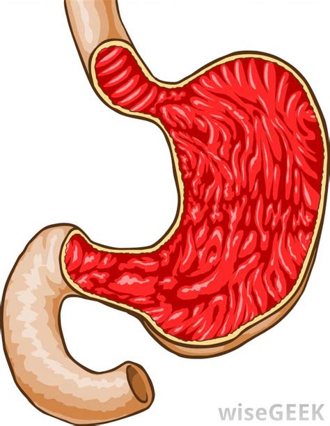 inflammation   duodenum  pictures
