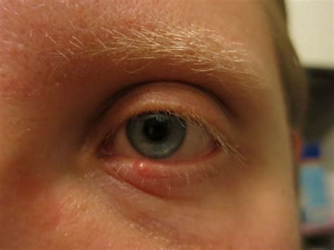 how to cure stye in eyelid naturally health inputs