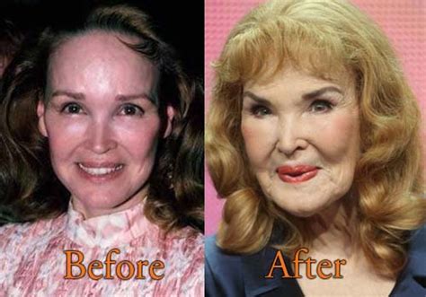 Kathryn Crosby Plastic Surgery Before And After Facelift