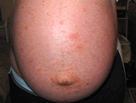 pupps rash in pregnancy—natural treatments mama natural