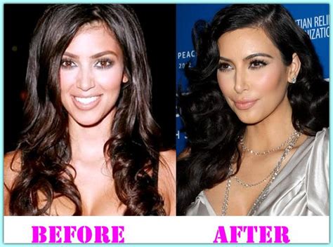 Kim Kardashian Plastic Surgery Before And After Kim