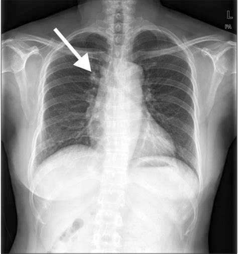 The Initial Chest Radiography At Our Institute Shows Th Open I