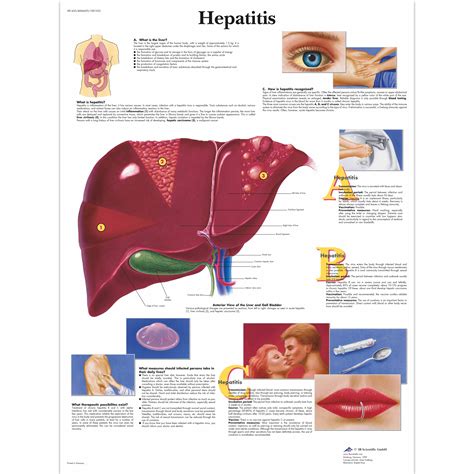 hepatitis  fact sheet hepatitis  jul   hepatitis    liver disease caused