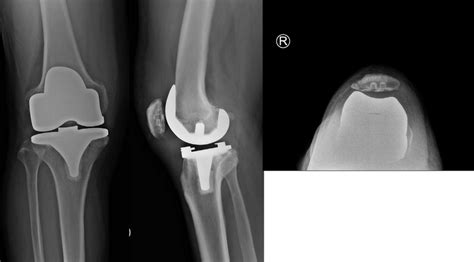 radiographs  tka   osteoarthritic knee  scientific
