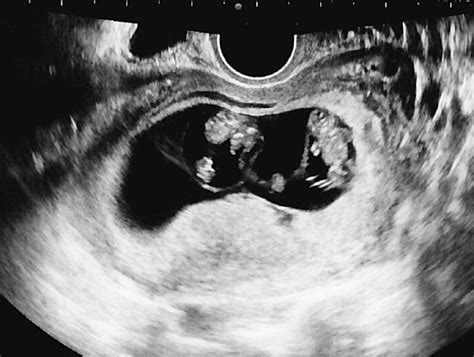 single embryo transfer  ivf  results  twins