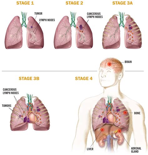 lung cancer symptoms causes diagnosis and treatment how to relief